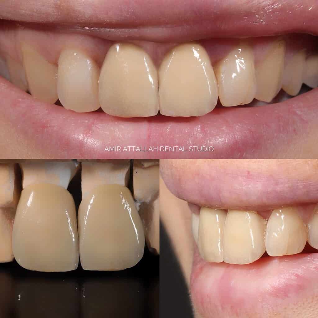 MrMarchi's tweet photo. Dental Crowns: The #Science Behind ...

-- Science | The ...: https://t.co/17k0smmtts.

#2023 #Ai #Article #Articles #Cdn #Cells #Cement #DentalCrowns #Earth #Form #Forms #Full #Gold #Health #HTML #Issues #It #Life #Material #Materials #Max #Maxwidth #Model #Nanomaterials ... https://t.co/BK4rNPSWUT