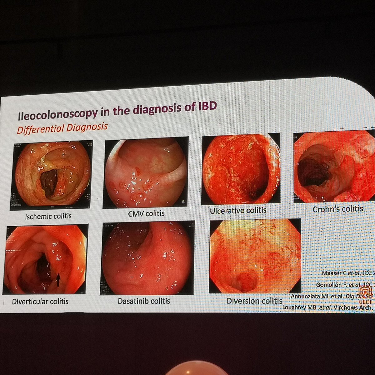GEDII_IBD's tweet image. 🚨 #Advancedcourse on #IBD endoscopy endorsed by @Y_ECCO_IBD
🎯 Diagnosis
- ileocolonoscopy is mandatory
- segmental biopsies are required
- upper endoscopy for pediatric and selected adults only
- many techniques in the horizon to reduce inter-observer variability