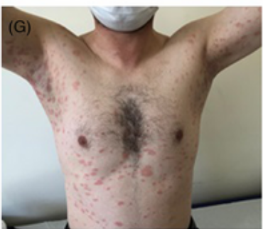 AdverseReports's tweet photo. 40 year old male
Pityriasis rosea-like eruption 7 days after the #Pfzer #mRNA shot
https://t.co/kiKUTSHI1R https://t.co/YnJrfZMnFv