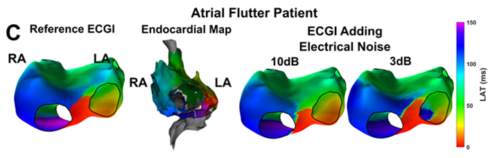rubenmolero_'s tweet photo. Check out this example of a #LAT map of an atrial flutter, where we were able to identify the same propagation pattern using #ECGI, endocardial mapping, and even when introducing additional electrical noise to the #BSPM signals. https://t.co/c0qqjdJZ0j