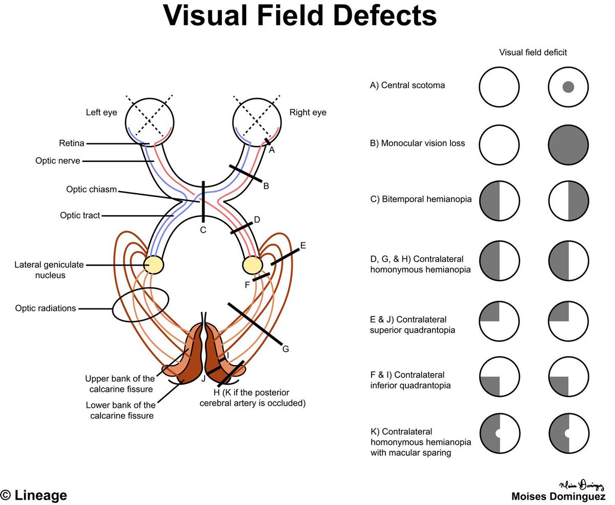 Medical_MD1's tweet image. Great Recap 🧐

Visual Field Defects✨👁️ 

.