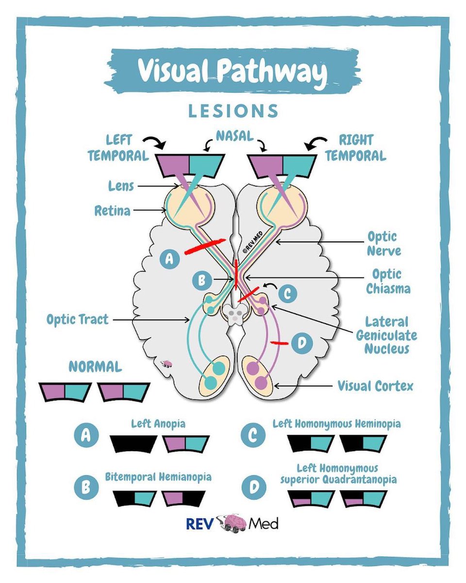 Medical_MD1's tweet image. Great Recap 🧐

Visual Field Defects✨👁️ 

.