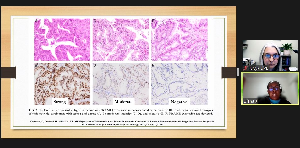 AnneMillsMD's tweet photo. Dr. Diana Jaravaza did a lovely job presenting our PRAME study from for @IJGynP Journal Club!  All three presenters did a superb job. @JDCo2pock @ISGyp @sarahgradeckimd @UVA_Pathology #UVAPath https://t.co/odmUXjEVY7