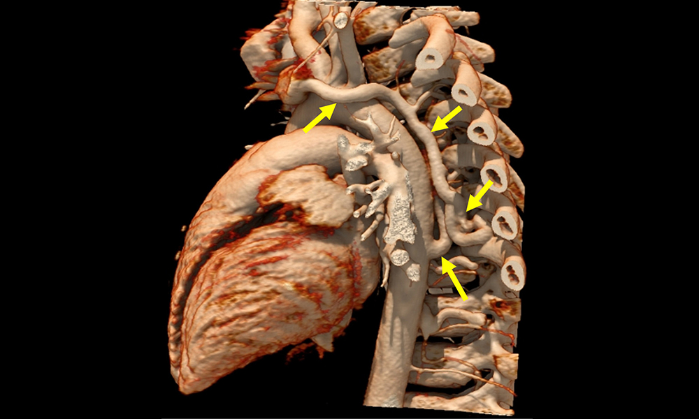 ASE360's tweet photo. We describe an asymptomatic pediatric patient who presented with a 3/6 harsh, blowing, continuous murmur audible along the left posterior scapular border.

Read our @CASEfromASE article, "Continuous Murmur in a Child: Sometimes It Is a Zebra!" https://t.co/w0GBUoTRz4 https://t.co/2SfQrCy9wX