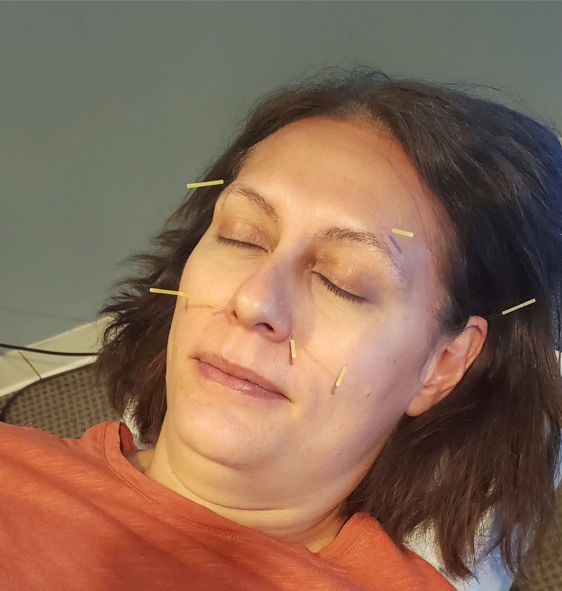 lakesidesports's tweet photo. We’re in the thick of pollen season, and did you know we can help with your allergies?🤧

Acupuncture has been shown to help with allergy/sinus congestion along with pressure &amp; inflammation almost immediately.

Come see us!

#lakesidesportschiro #wellnesswednesday #chiropractor https://t.co/9h1N7BcunC