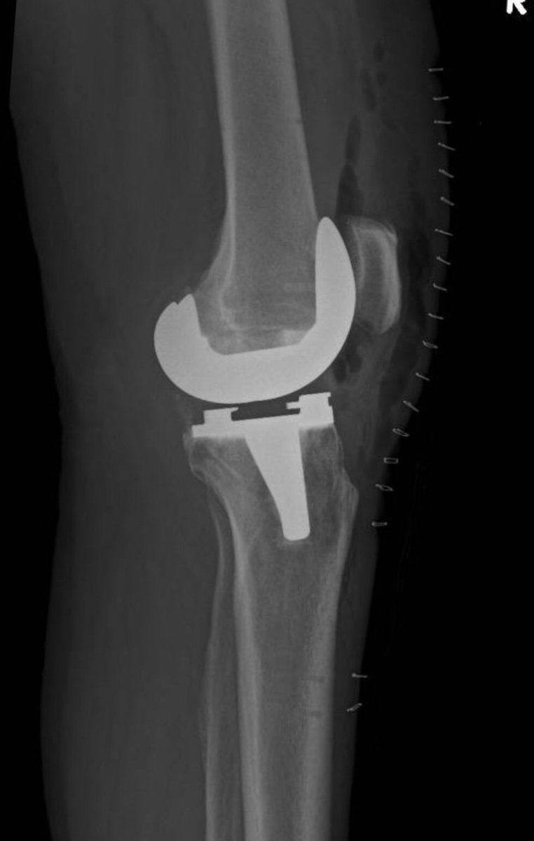 mirandaortho's tweet photo. Un caso más de éxito de Protesis de Rodilla con Cirugía Robótica, en @CIMAHMO somos pioneros en el Noroeste del país con uso de #RobotROSA, técnica novedosa que resuelve el problema de dolor y recupera la función articular del paciente. @gilbertoungson @torremedicacima https://t.co/Uq2KPr2EH6