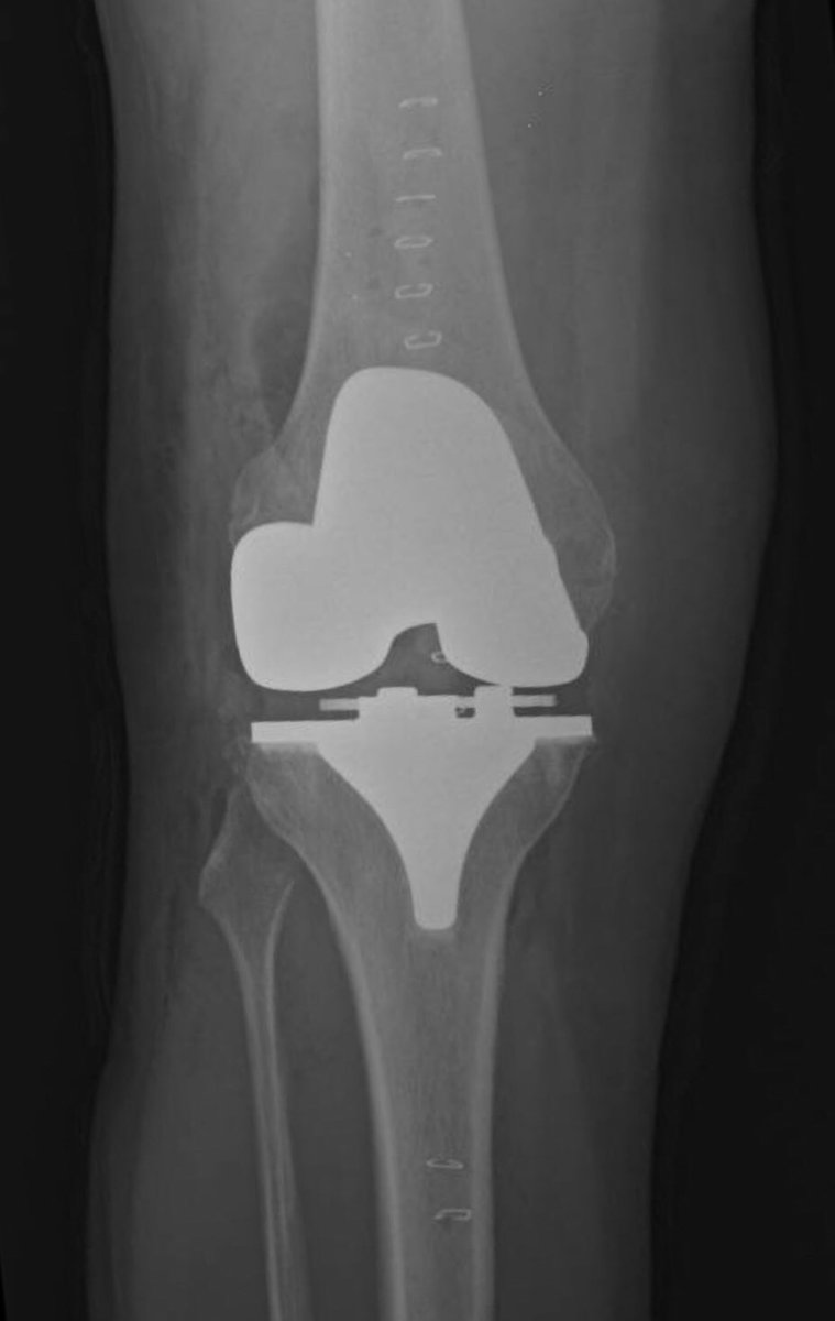 mirandaortho's tweet photo. Un caso más de éxito de Protesis de Rodilla con Cirugía Robótica, en @CIMAHMO somos pioneros en el Noroeste del país con uso de #RobotROSA, técnica novedosa que resuelve el problema de dolor y recupera la función articular del paciente. @gilbertoungson @torremedicacima https://t.co/Uq2KPr2EH6