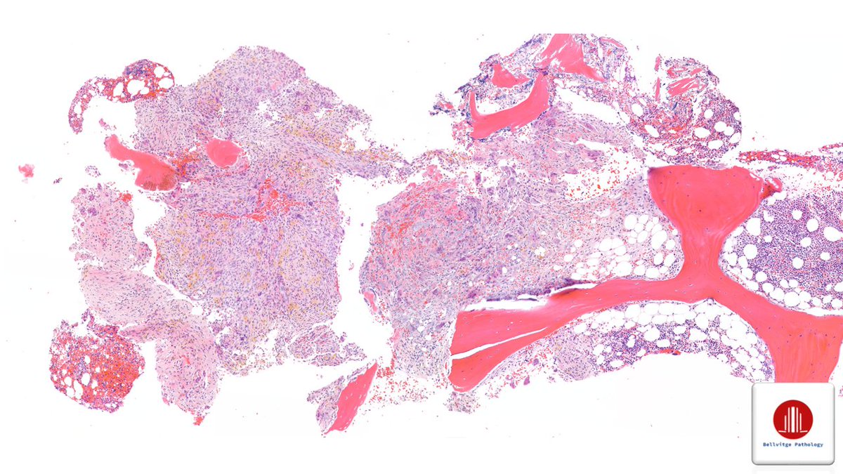 bellvitgepath's tweet photo. So it all fits: the bone lesion is a nice example of 𝐛𝐫𝐨𝐰𝐧 𝐭𝐮𝐦𝐨𝐫 (𝐠𝐢𝐚𝐧𝐭 𝐜𝐞𝐥𝐥 𝐫𝐢𝐜𝐡 𝐥𝐞𝐬𝐢𝐨𝐧) 𝐢𝐧 𝐭𝐡𝐞 𝐬𝐞𝐭𝐭𝐢𝐧𝐠 𝐨𝐟 𝐩𝐫𝐢𝐦𝐚𝐫𝐲 𝐡𝐲𝐩𝐞𝐫𝐩𝐚𝐫𝐚𝐭𝐡𝐲𝐫𝐨𝐢𝐝𝐢𝐬𝐦, "brown" due to the presence of hemosiderin. https://t.co/B7BxsST6l3