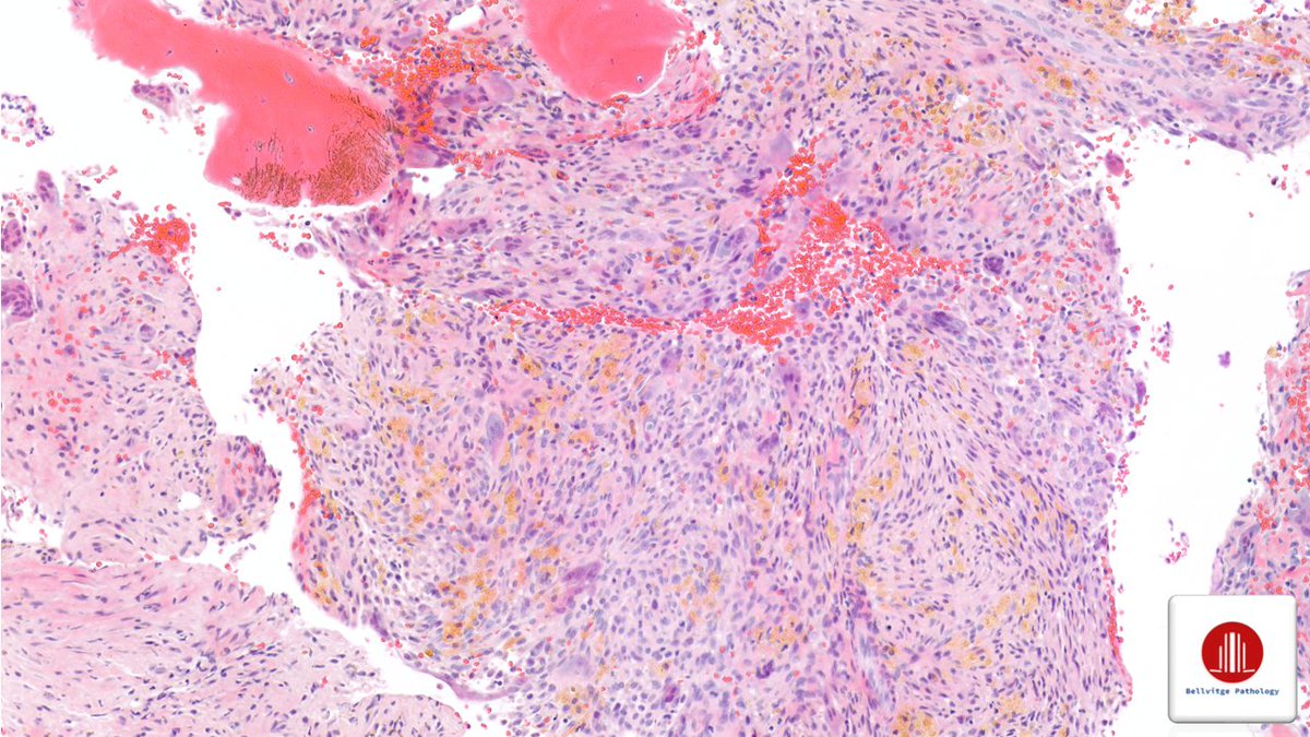 bellvitgepath's tweet image. Woman in her 60s with an upper mediastinal mass.
Multiple axial osteolytic lesions.
 
#BSTPath #BellvitgePath