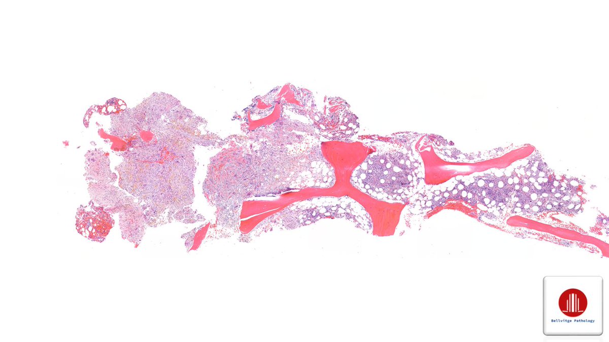 bellvitgepath's tweet image. Woman in her 60s with an upper mediastinal mass.
Multiple axial osteolytic lesions.
 
#BSTPath #BellvitgePath