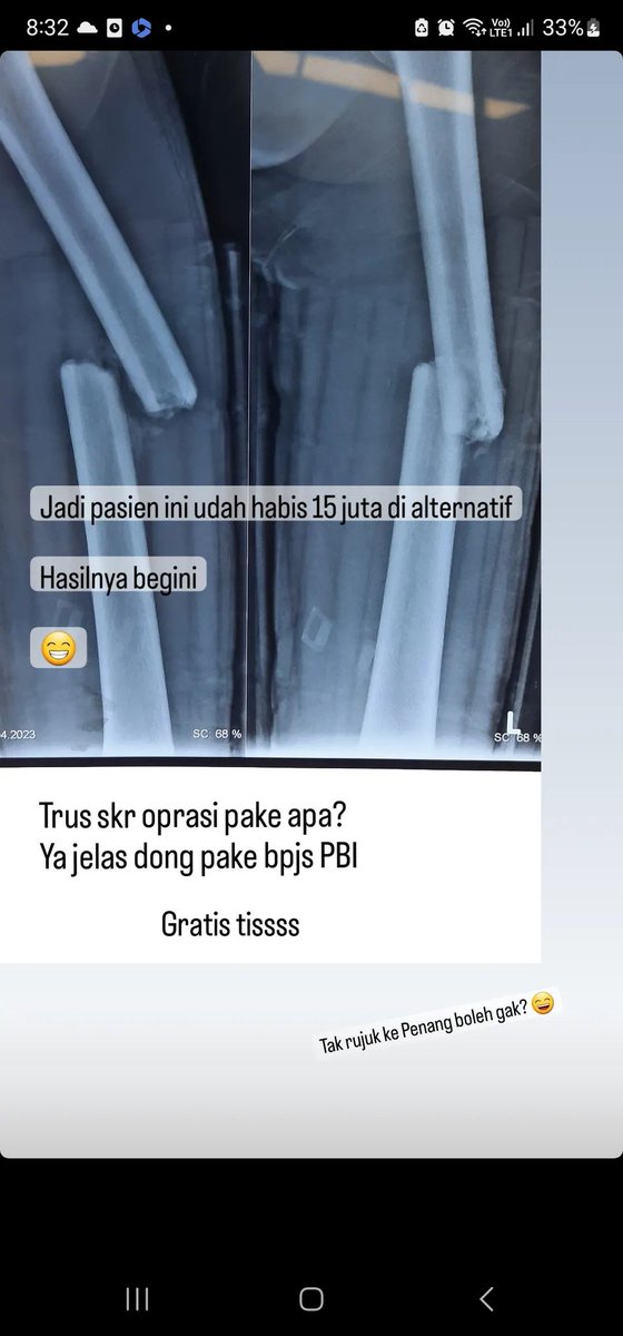 Story seorang senior dokter bedah tulang barusan

dikira berobat alternatif itu murah?
Ini kasus berbulan2 berobat alternatif, dipijat terus menerus, dibilang sudah bagus sudah bagus, udah abis 15 jt(pdhl punya BPJS)

Tidak bisa jalan, kaki pendek sebelah, tulang tdk menyatu 😭