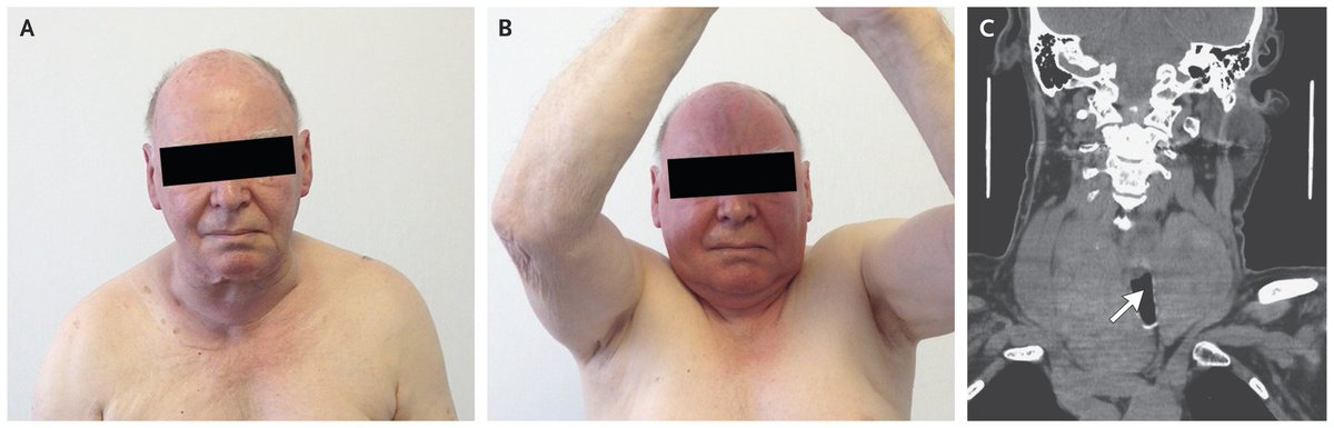 caffeinatedmd's tweet photo. Pemberton’s sign➡️reversible facial congestion after elevation of both arms. Indicates superior vena cava syndrome from obstruction of the thoracic inlet, in this case, by the enlarged thyroid gland compressing the subclavian and jugular veins.
Panel C➡️patent trachea deviated. https://t.co/ozFhgyTPaj