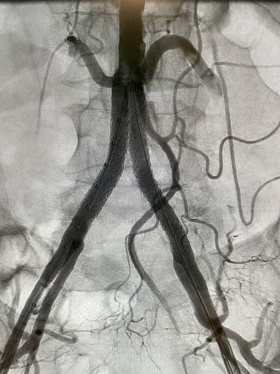CYDAR useful in guiding endovascular treatment of aorto-iliac occlusive disease ⁦<a href="/ETZnl/">ETZ</a>⁩ ⁦<a href="/Til_Surg/">Chirurgen Tilburg</a>⁩ ⁦