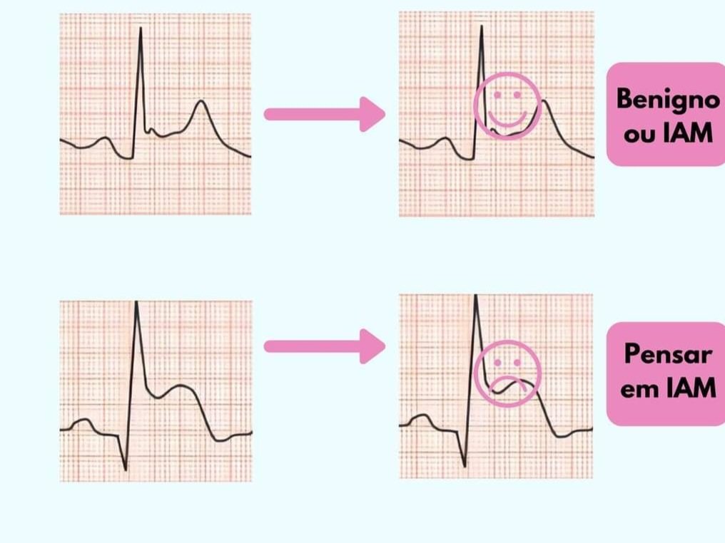 brunobalencar's tweet photo. Você tem medo de Supradesnivelamento do segmento ST no ECG ?

Clique abaixo :

https://t.co/xnqeIph5wy https://t.co/RLbTMaZOEg
