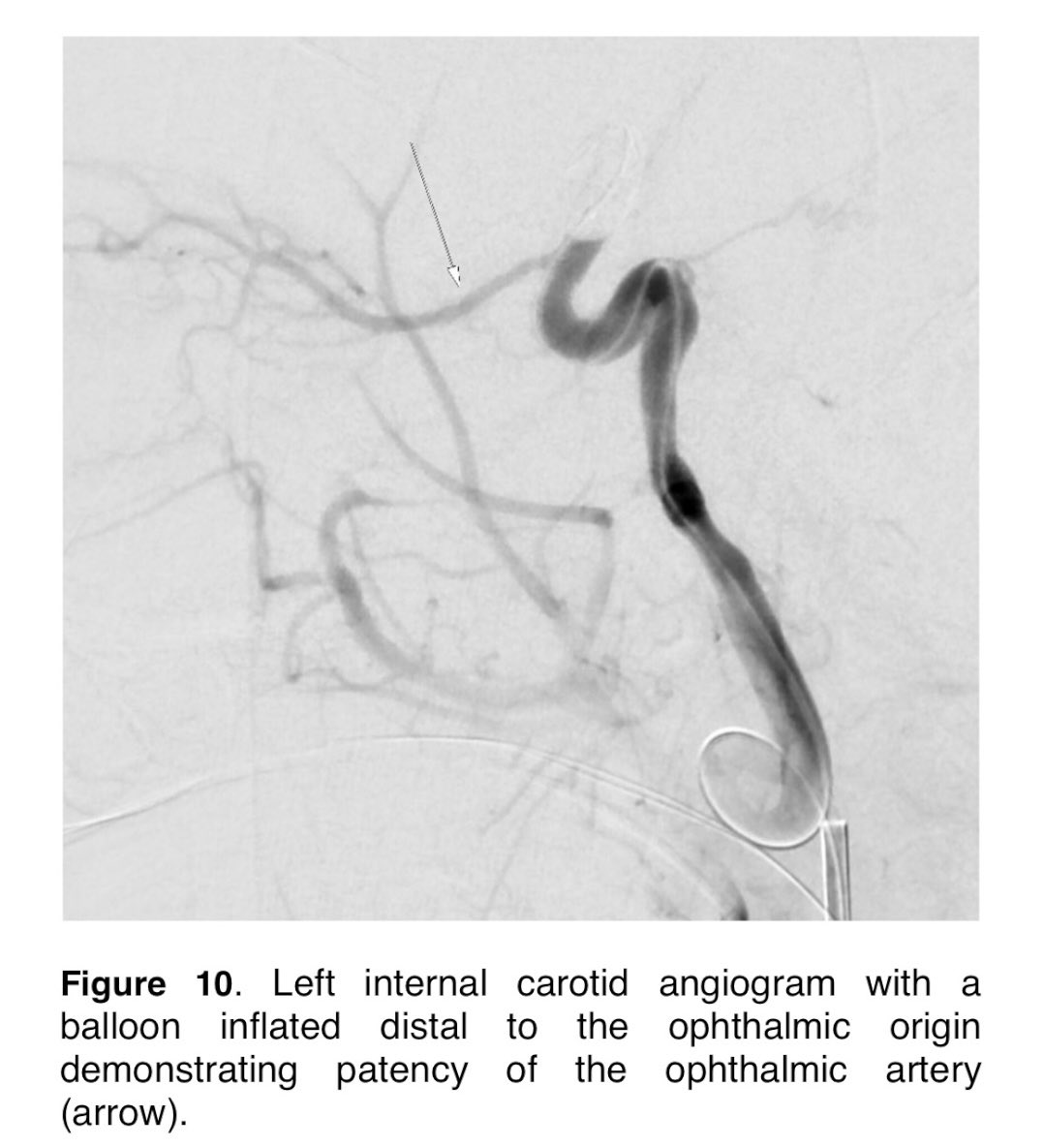 evanluthermd's tweet photo. Utilizing creative endovascular techniques for complex problems is what makes our job so rewarding!
Thanks @KrisnaSMaddy and @AshiaHackett for spearheading these projects! @UMneurosurgery
#endovascular #cerebrovascular #aneurysm #transradialaccess #arterialusoria #ophthalmic https://t.co/B96ZcwANQB