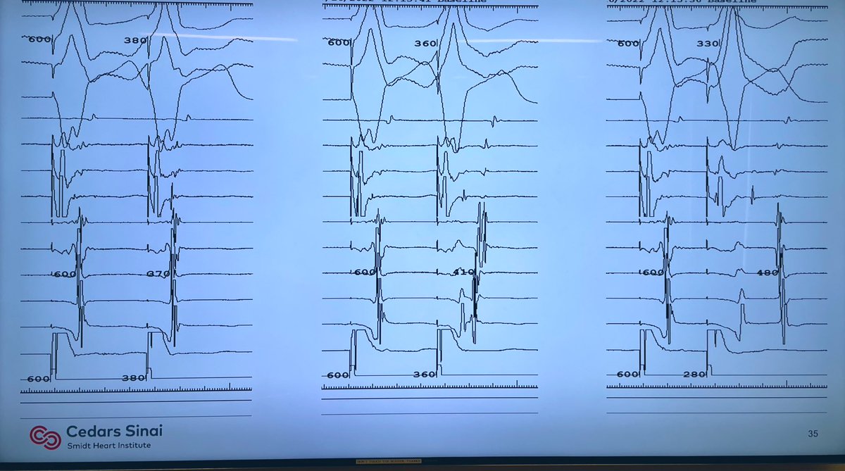 EhdaieMd's tweet photo. Beautiful summary slide of EPS for SVT by J.Lerner EP fellow during #EPConference ๐ช๐ผ๐ฅ๐คฉ@CedarsSinaiMed
#EPfellows #Epeeps what is the mechanism of retrograde conduction?
Poll ๐ https://t.co/gAlchrfR53