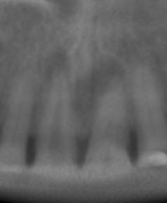 RayXDiagnostics's tweet photo. Tooth #8 with #endodontic lesion (apical periodontitis)
Tooth #9 with diffuse periapical radiolucency
#CBCT shows the origin of the lesion on #9 being a developing nasopalatine canal cyst. #dentistry @drbicuspid @Dentaltown @DentistryToday https://t.co/uJVSme6Trt