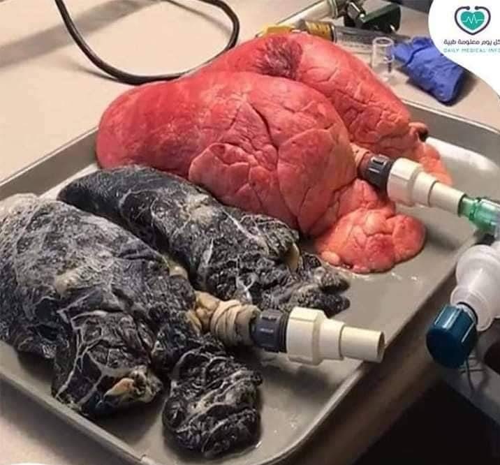 Cette image montre la différence entre le poumon du fumeur (en noir) et le poumon du non-fumeur.

Nous espérons à travers celle-ci montrer la dangerosité du tabagisme.