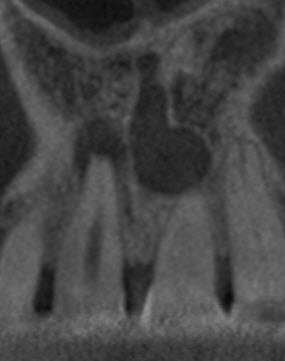 RayXDiagnostics's tweet photo. Tooth #8 with #endodontic lesion (apical periodontitis)
Tooth #9 with diffuse periapical radiolucency
#CBCT shows the origin of the lesion on #9 being a developing nasopalatine canal cyst. #dentistry @drbicuspid @Dentaltown @DentistryToday https://t.co/uJVSme6Trt