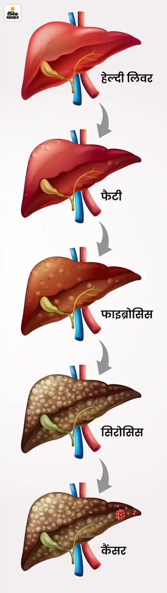 DainikBhaskar's tweet photo. शराब नहीं पीते फिर भी लिवर खराब: फैटी लिवर के लिए समोसा-पिज्जा जिम्मेदार, रहें अलर्ट वर्ना जा सकती है जान; जानें इलाज
#Health #fitness #fattylever
अधिक खबरें और ई-पेपर पढ़ने के लिए दैनिक भास्कर ऐप इंस्टॉल करें - https://t.co/hO3HVqcM49 https://t.co/5EXrUCl8Qo