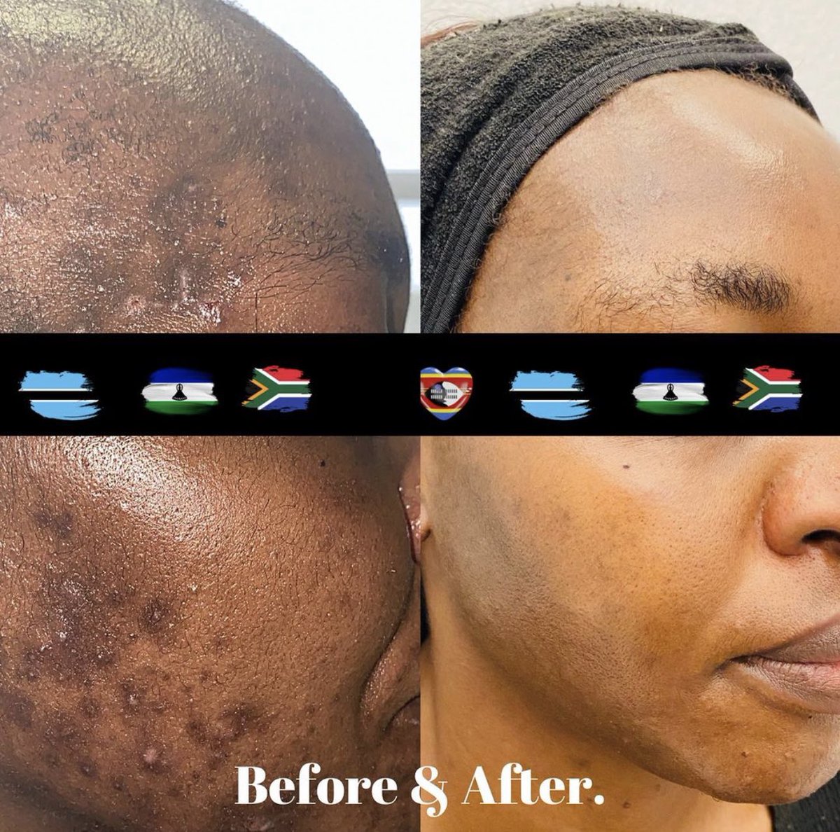 DRFRESHPRP's tweet image. About Us:
💫
Mission:
𝗢𝘂𝗿 𝗺𝗶𝘀𝘀𝗶𝗼𝗻 𝗶𝘀 𝘁𝗼 𝗵𝗲𝗹𝗽 𝘆𝗼𝘂 𝗿𝗲𝗳𝗿𝗲𝘀𝗵 𝘆𝗼𝘂𝗿 𝗰𝗼𝗻𝗳𝗶𝗱𝗲𝗻𝗰𝗲, 𝗮𝗹𝗹𝗼𝘄𝗶𝗻𝗴 𝘆𝗼𝘂 𝘁𝗼 𝗳𝗲𝗲𝗹 𝗰𝗼𝗺𝗳𝗼𝗿𝘁𝗮𝗯𝗹𝗲 𝗶𝗻 𝘆𝗼𝘂𝗿 𝗼𝘄𝗻 𝘀𝗸𝗶𝗻. 

#retweet for support l🙏🏽