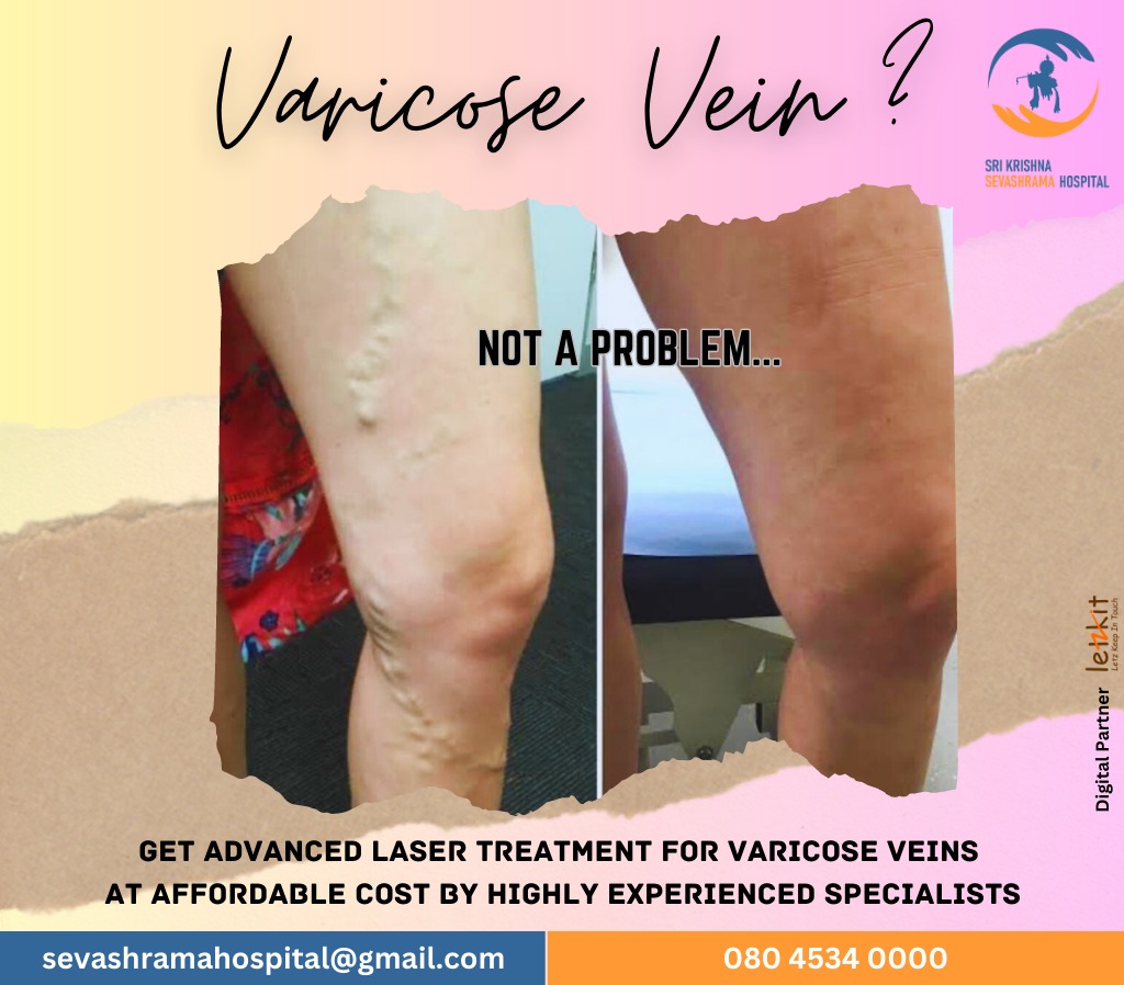 sksevashrama's tweet photo. Suffering from Varicose Vein?
Get treated by our specialists using the latest Laser Tech 🩺
#SKSHospital #SriKrishnaSevashrama #VaricoseVein #VaricoseVeinTreatment #lasertherapy #laproscopicsurgery #charityhospital #bangalore #Letzkit https://t.co/M4oKTwPnm6