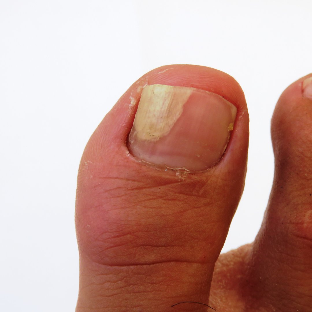 SyracuseFeet's tweet photo. Are your toes ready for warm weather? After the long, cold winter, toenail fungus is a common problem. Let us help you get it under control. Learn more about toenail fungus and how our team at Syracuse Podiatry can help in our new blog: https://t.co/sMUJZ6Egh7 https://t.co/rjLRj8oyQi