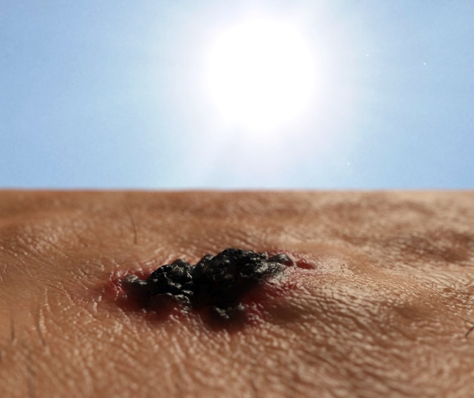 Gapodiatry's tweet photo. Now that the sun is out, your risk for skin cancer has returned. If you notice any abnormalities in your skin or nails, it doesn't hurt to get them checked out by our team at Georgia Podiatry. Our latest blog offers more information about skin cancer! https://t.co/Kc3eqEOCtV https://t.co/mgaty4WXG9