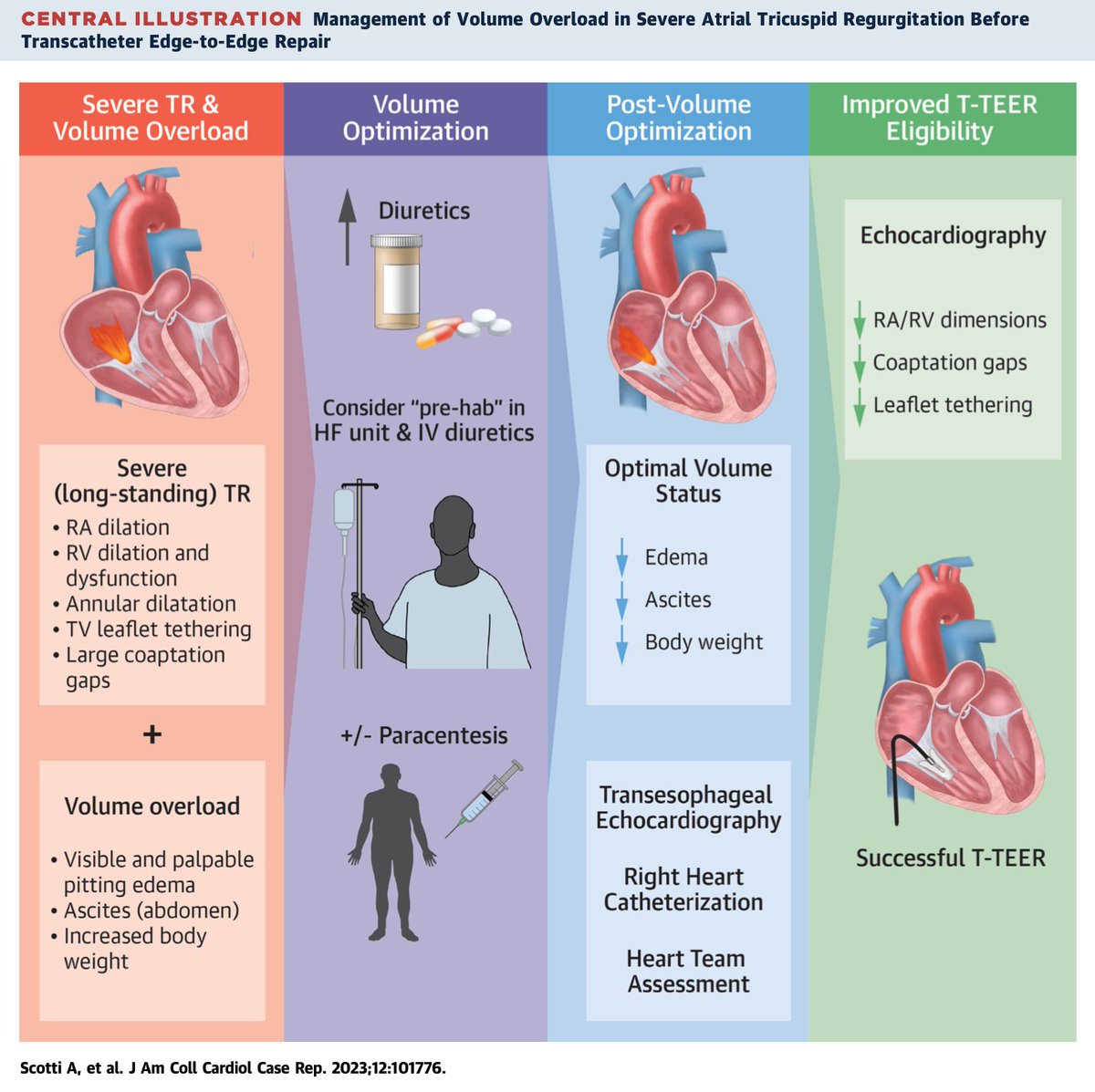 ✨Management of Volume Overload and Severe Atrial TR on @JACCJournals

Reversing Vol Overload can:
🎯Improve pt functional status
🎯Improve eligibility for TTVI
🎯Avoid repeating invasive exams

🌐 jacc.org/doi/10.1016/j.…

@azeemlatib @CurioJonathan
@MonteHeart #PCRTricuspid