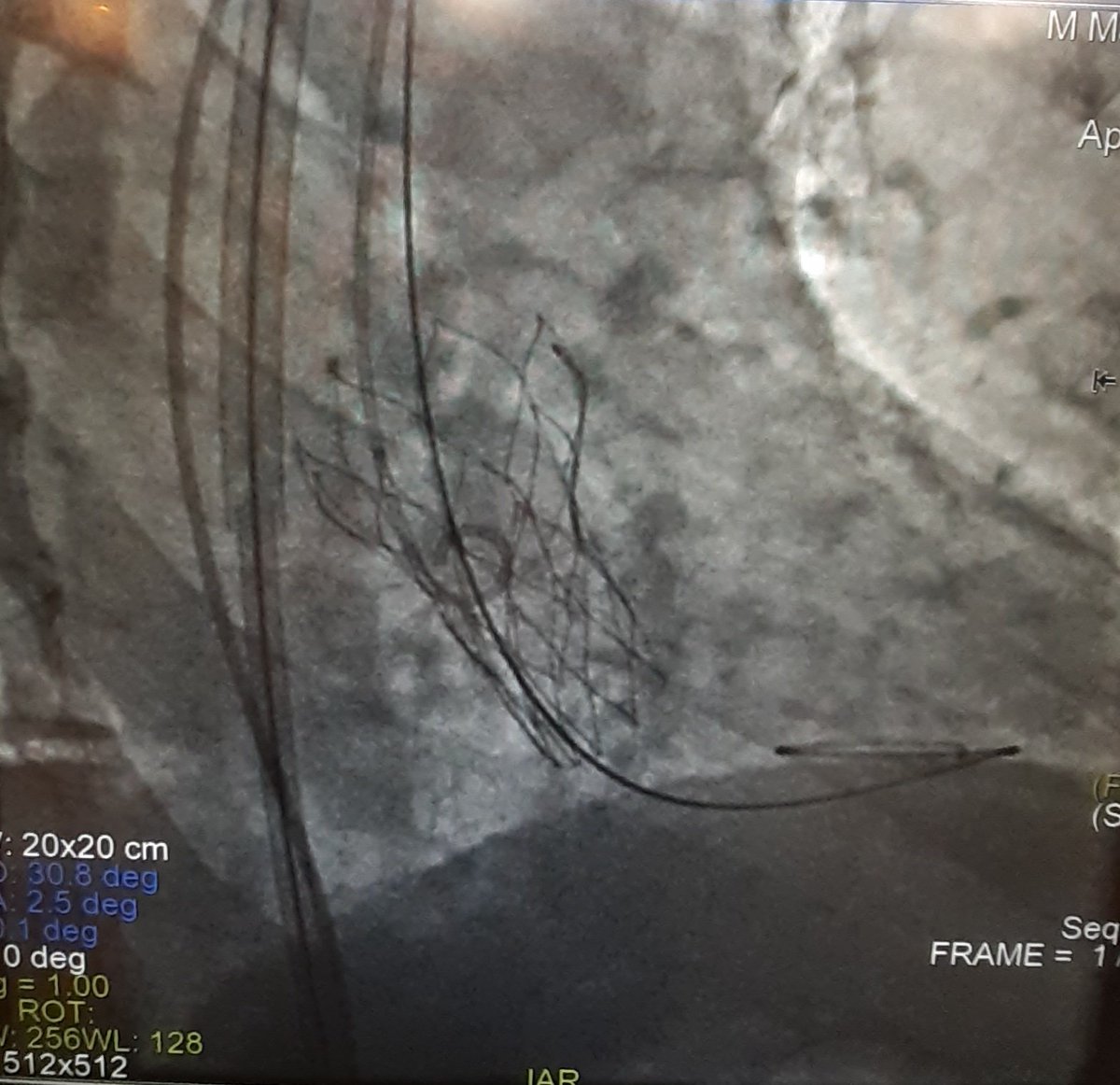 dr_cfp's tweet photo. @matiasrg @AlfredoERodrig2 @AbbottNews @CECICath @CACIarg @hemodinamiasac Acceso percutaneo derecho,valvuloplastia con marcapaseo por guia metalica,implante de #Navitor #abbott 27,cusp overlap, cierre con #proglide.alta sin trastornos de conduccion,<24 hs.@CACIarg @ComunidadFAC @hemodinamiasac @SAC_54 @CONAREC_ORG @SPCyCC @AbbottNews https://t.co/QqV8soSRhK
