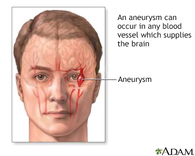 HealthtalkZW's tweet photo. *BRAIN ANEURYSM*

 *DEFINITION* 
A brain aneurysm (AN-yoo-riz-um) is a bulge or ballooning in a blood vessel in the brain. It often looks like a berry hanging on a stem.

A brain aneurysm can leak or rupture, causing bleeding into the brain (hemorrhagic stroke). Most often a https://t.co/dx4ouPz2Z0