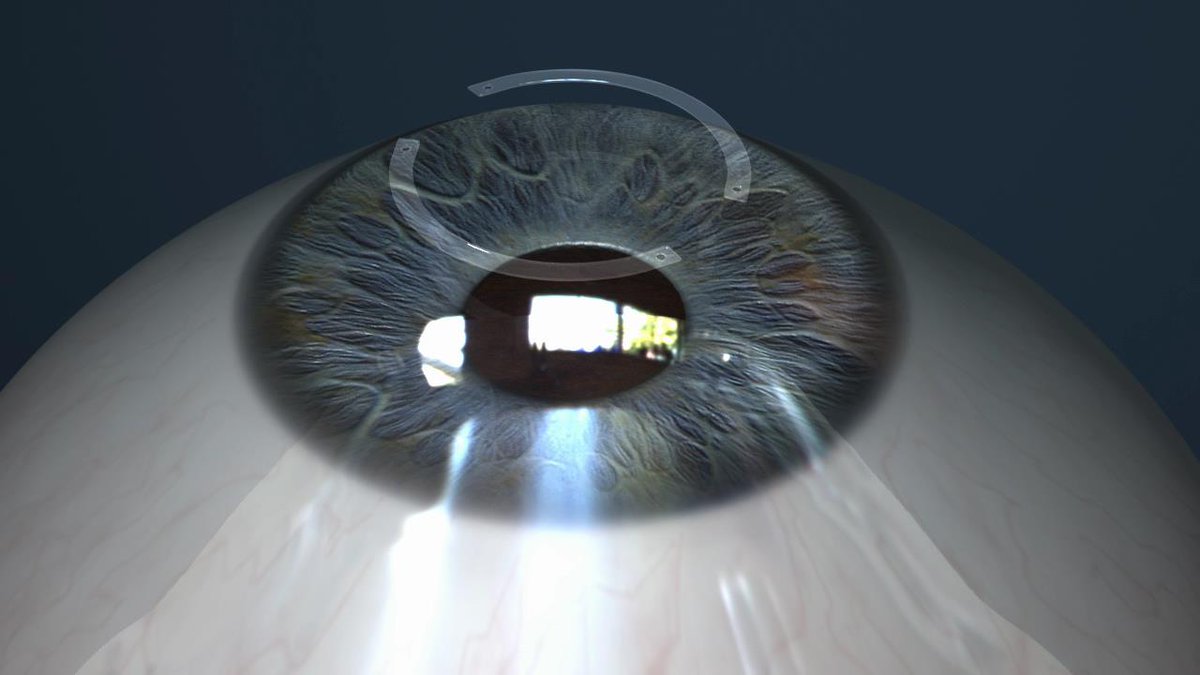 ow.ly/OGuI104Ei1p ow.ly/gT1L104EjjP The eye rubbing cycle study: Warnings for patients with keratoconus ... - Ophthalmology Times