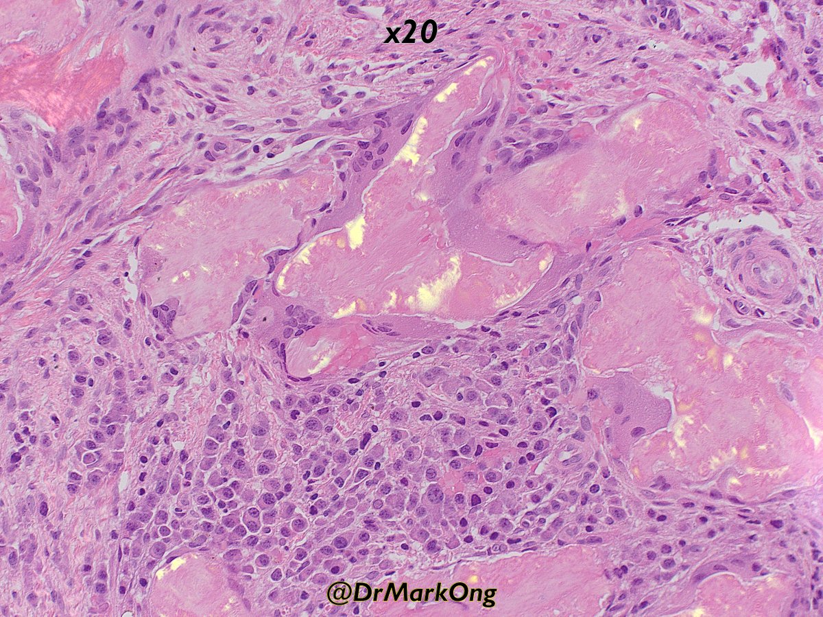 If there is enough amyloid, you may not need Congo Red to demonstrate birefringence, as demonstrated below on the H&amp;E.

The chemical(s) in Congo Red intercalate between amyloid fibrils, accentuating the inherent birefringence of the amyloid.