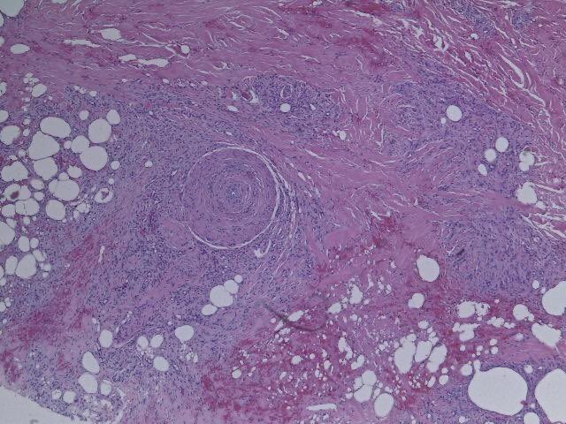 Úlcera en la pierna con dolor tipo isquemico en un paciente hipertenso con pulsos periféricos conservados . Úlcera de Martorell : arterioloesclerosis hiperplasica con estenosis luminal