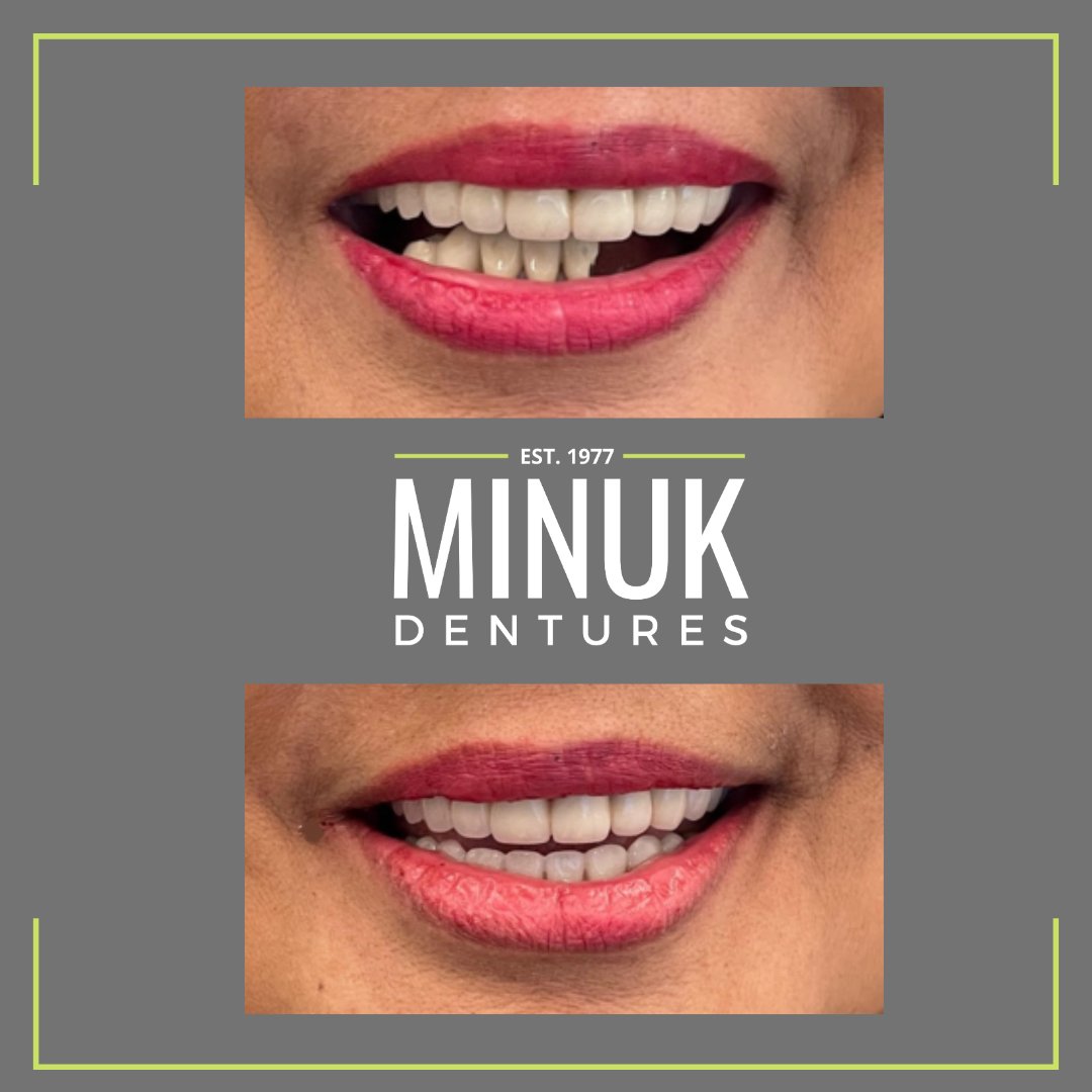 MinukSmile's tweet photo. Check out this Smile Transformation! 
 
All-on-4 Lower Restoration 

We offer free consultations &amp; second opinions to discuss all possible treatments for your smile. 
 
Call our office today at 204-589-6329 

#winnipegdentureclinic #winnipeg #denture #smiletransformation https://t.co/WEyOQXrCpg