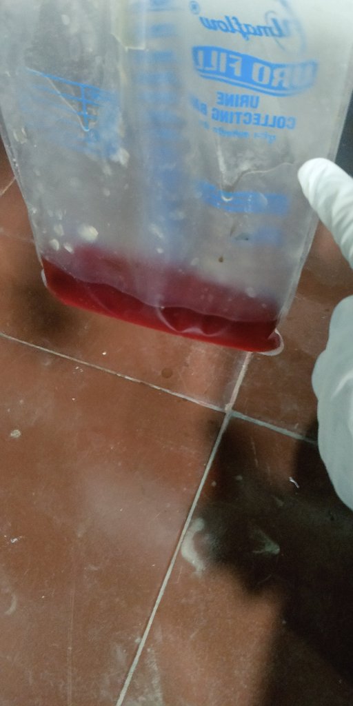 DrAdityaMD's tweet photo. Couple of urines that you will encounter frequently while working in an Indian hospital.
Red: Pt. had Iron Sucrose going on.
Orange: Pt. had ββββdrug going on.
#MedTwitter #nephrology #urine #drugeffect #tuberculosis #medicine https://t.co/gvN7eAGXIU