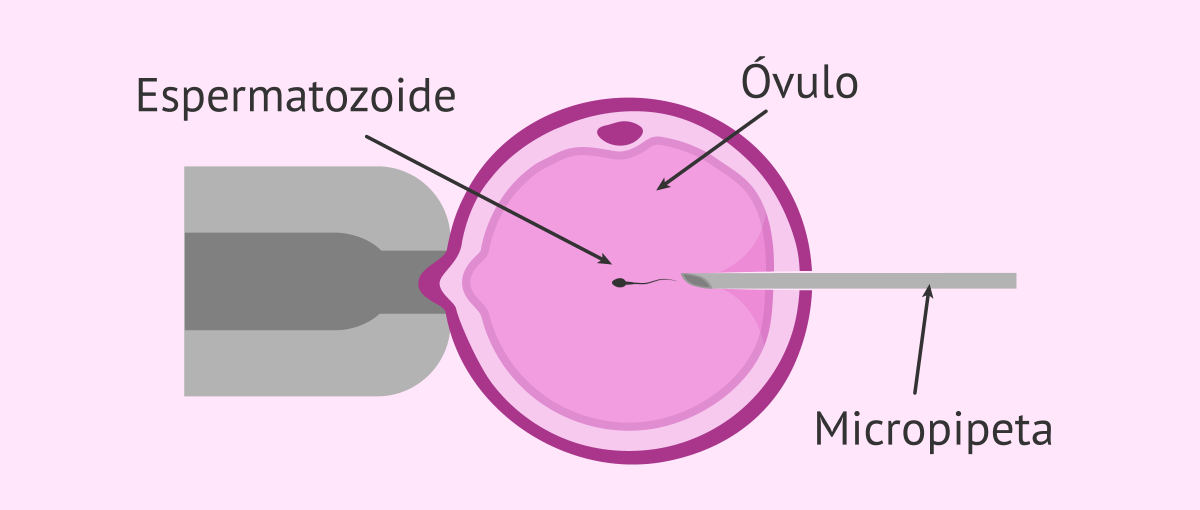 DrAxelCayetano's tweet photo. 🔬 La obesidad en hombres pone en riesgo el éxito de técnicas como FIV o ICSI en la búsqueda de ser padres 💔 #HombresSaludables #FertilidadEnPeligro https://t.co/ueTy2CBcgC