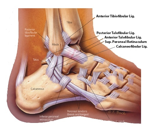 PhysioNetwork's tweet photo. 💥 Lateral Ankle Sprain (LAS) Intrinsic Risk Factors in Adolescents

Study that followed athletes over 2 seasons found:
✅ Previous LAS
✅ Navicular drop
✅ Knee recurvatum

📲 https://t.co/PskPadaV0i https://t.co/pO62XAecaX