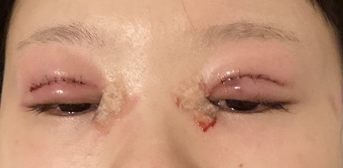 nafukasu's tweet photo. DT0日目(施術2時間後くらい)

写真撮る気力なくて寝てる状態で撮ったので参考にならないかも…涙目ですね笑
術直後からかなり腫れてて痛かったので家帰って少しご飯食べて痛み止めと他の薬飲んで即就寝しました https://t.co/4DOacmrST2
