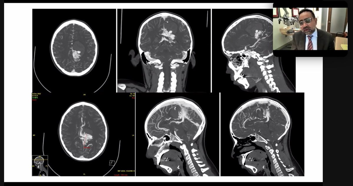 A brilliant session reviewing nuanced management of vascular pathology with <a href="/BrainAVMsurgeon/">Nirav J Patel, MD</a> Dr Nirav Patel <a href="/BWHNeurosurgery/">Brigham and Women's Neurosurgery</a> Thanks for volunteering your time and expertise! <a href="/MayoClinicNeuro/">Mayo Clinic Neuro</a> <a href="/MCNeurovasc/">Mayo Clinic Neurovascular</a>