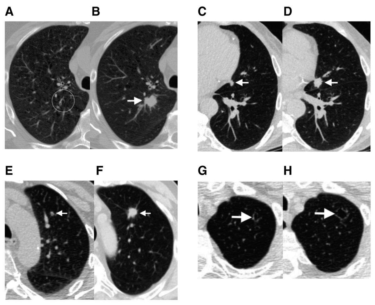 ATSMedEd's tweet photo. On our #ATSMeded #TechTuesday. Let review the work of P. Mikhael et al,  Sybil "A Validated Deep Learning Model to Predict Future Lung Cancer Risk From a Single Low-Dose ChestCT"was able to predict lung cancer risk up to 94% in 1 year and 80% in 6 years. https://t.co/gk5iPWhnJp https://t.co/kyQp4NVih5