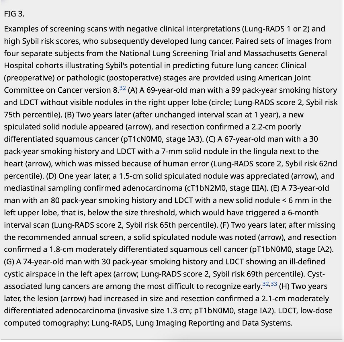 ATSMedEd's tweet photo. On our #ATSMeded #TechTuesday. Let review the work of P. Mikhael et al,  Sybil "A Validated Deep Learning Model to Predict Future Lung Cancer Risk From a Single Low-Dose ChestCT"was able to predict lung cancer risk up to 94% in 1 year and 80% in 6 years. https://t.co/gk5iPWhnJp https://t.co/kyQp4NVih5