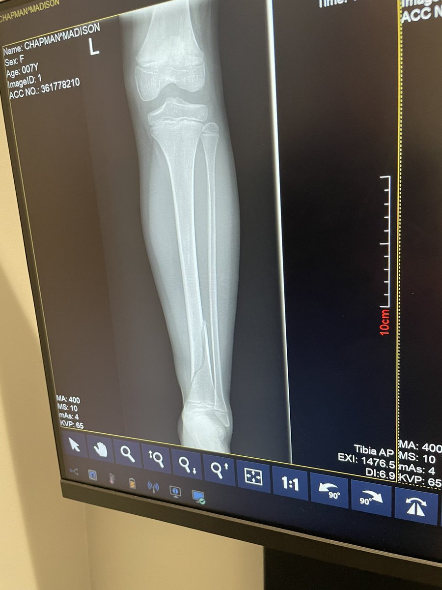 JettRink07's tweet photo. Nothing like some mid week runs to urgent care and ER for our 7yo girl. Anyone know a good ortho in houston area? That fracture seems a little too close to growth plate for my liking and want to get an opinion or two.
#eft #toughgirl #ialmostfainted #houston #brokenbone https://t.co/akCH7arzS8