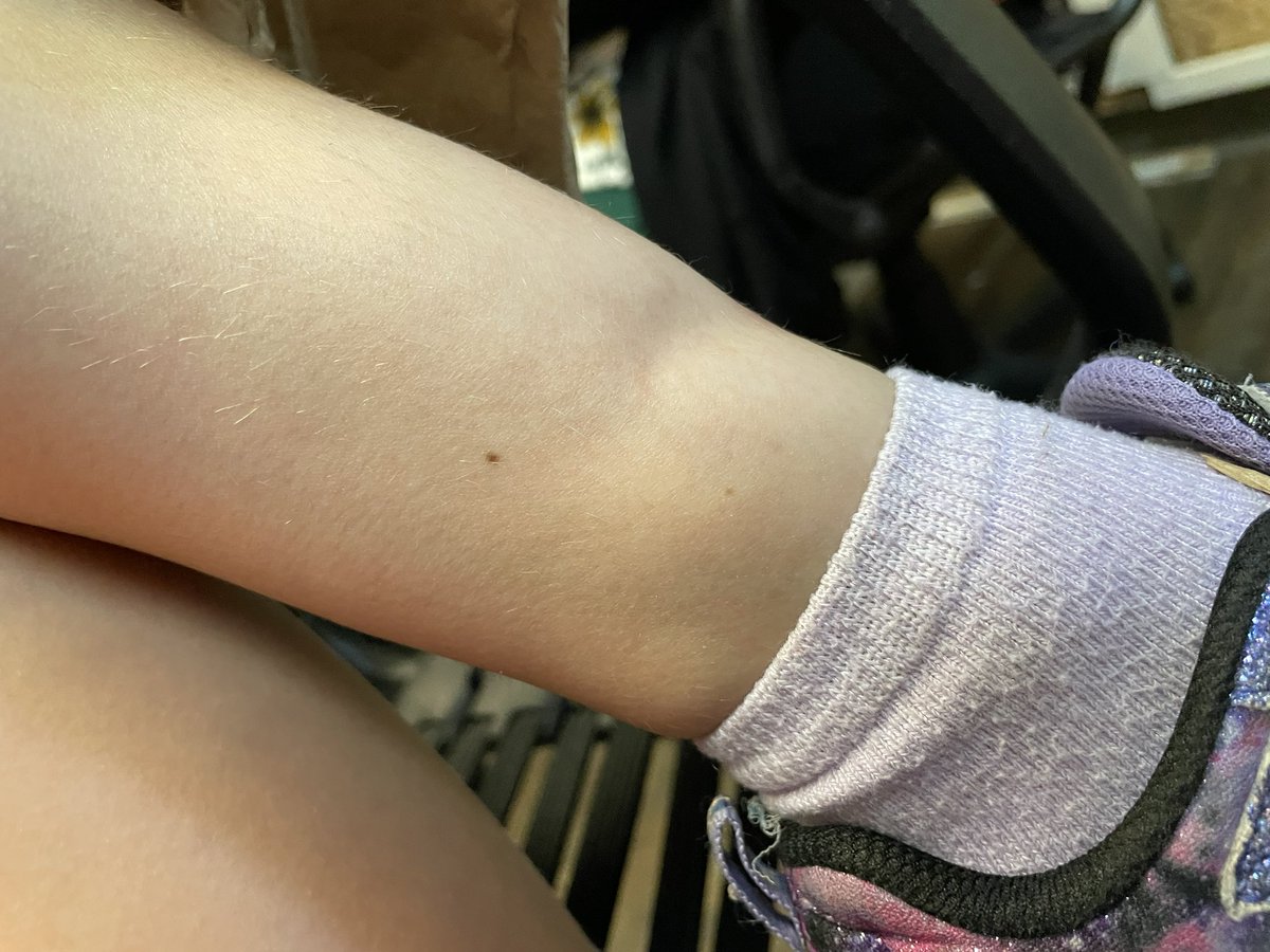 JettRink07's tweet photo. Nothing like some mid week runs to urgent care and ER for our 7yo girl. Anyone know a good ortho in houston area? That fracture seems a little too close to growth plate for my liking and want to get an opinion or two.
#eft #toughgirl #ialmostfainted #houston #brokenbone https://t.co/akCH7arzS8