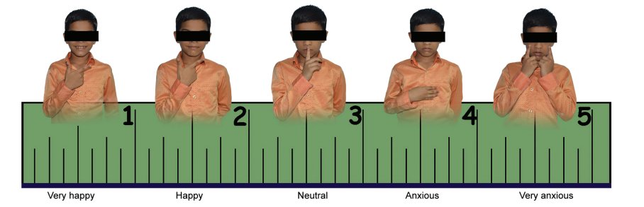Anxiety Rating Scale for Speech and Hearing-impaired Children ijcpd.com/doi/IJCPD/pdf/… #Anxietyassessmentscale #Dentalanxiety #Hearingimpairment #Pediatricdentistry #Speechimpairment #PrathimaGShivashankarappa #NikhilMarwah #IJCPD #JaypeeJournals