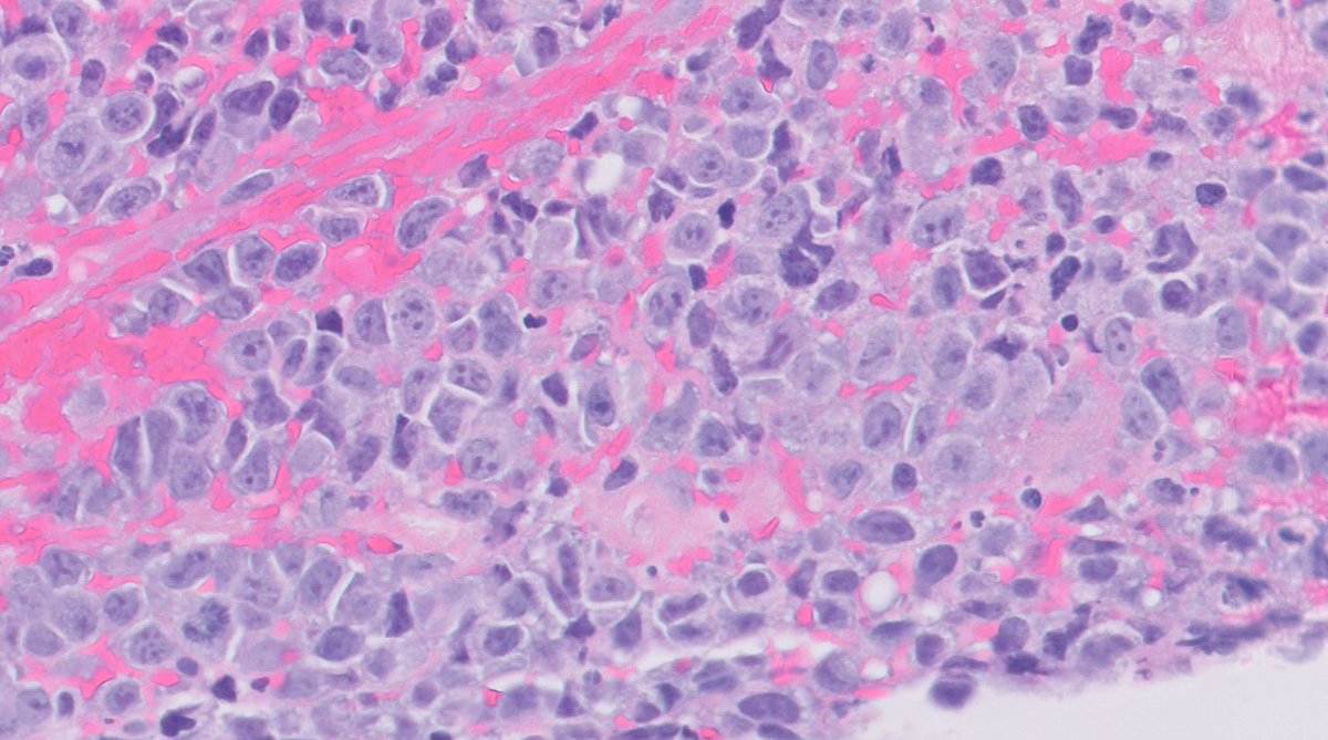 OOPathMD's tweet photo. Colonic mass in elderly individual.  Thoughts? Suggested IHC? https://t.co/eREHjhUfoM