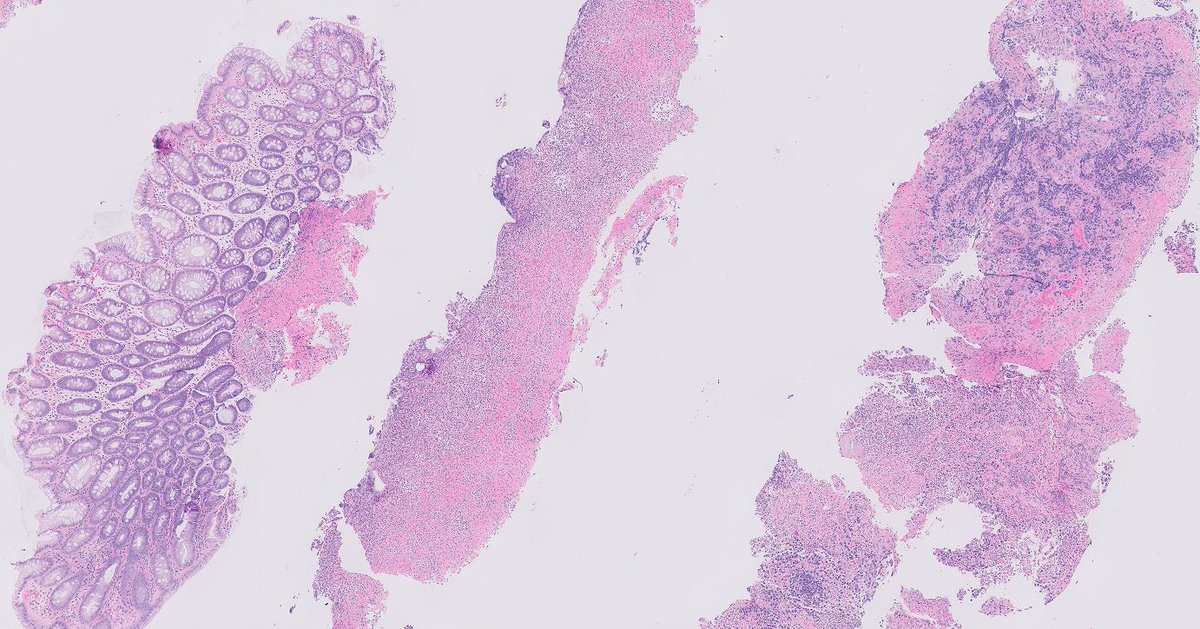 OOPathMD's tweet photo. Colonic mass in elderly individual.  Thoughts? Suggested IHC? https://t.co/eREHjhUfoM