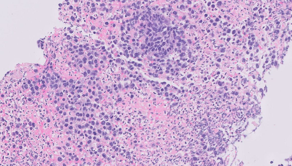 OOPathMD's tweet photo. Colonic mass in elderly individual.  Thoughts? Suggested IHC? https://t.co/eREHjhUfoM