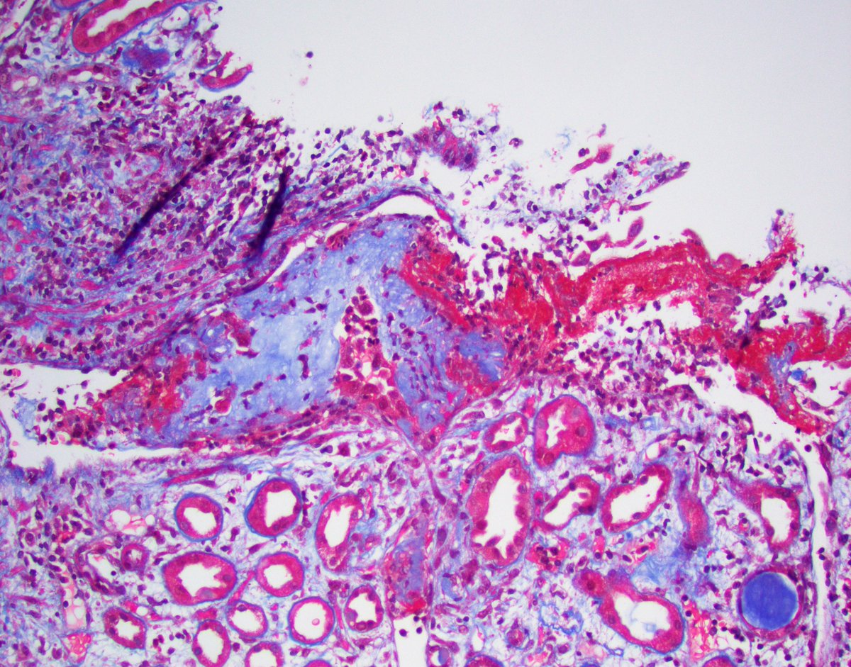 JZRenalPath's tweet photo. A not so uncommon finding (but not frequently discussed) in a kidney bx: tubulovenous fistula/herniation. Communication between a ruptured tubule &amp; vein with intravasuclar Tamm-Horsfall protein + thrombus. Can result in massive hematuria without a GN. #renalpath #PathTwitter https://t.co/oa9ky69Cw0