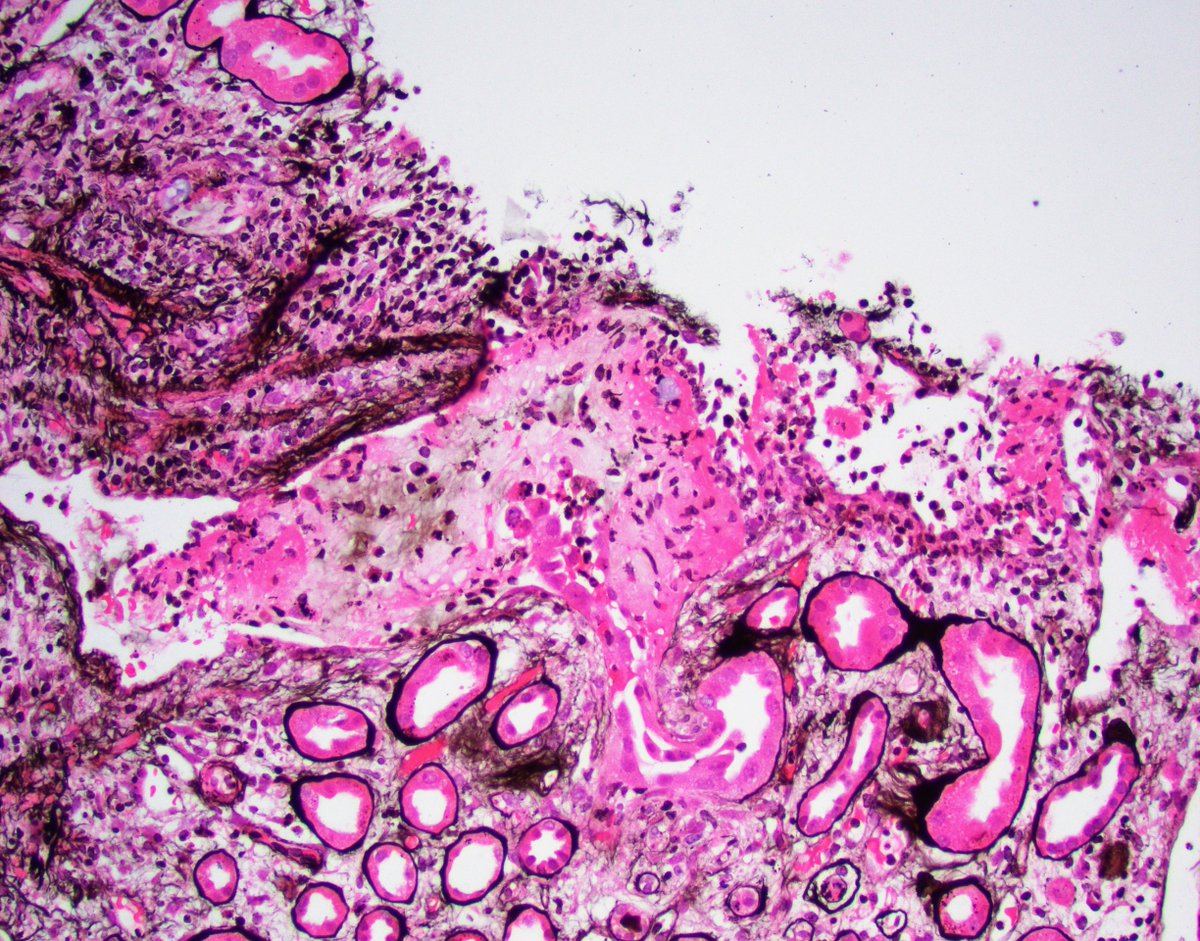 JZRenalPath's tweet photo. A not so uncommon finding (but not frequently discussed) in a kidney bx: tubulovenous fistula/herniation. Communication between a ruptured tubule &amp; vein with intravasuclar Tamm-Horsfall protein + thrombus. Can result in massive hematuria without a GN. #renalpath #PathTwitter https://t.co/oa9ky69Cw0
